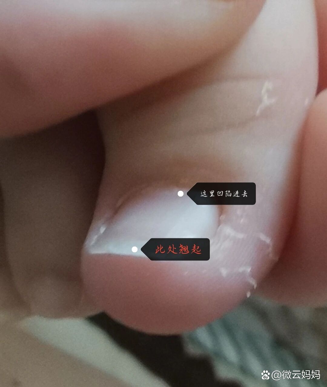 宝宝脚趾甲盖向上翘