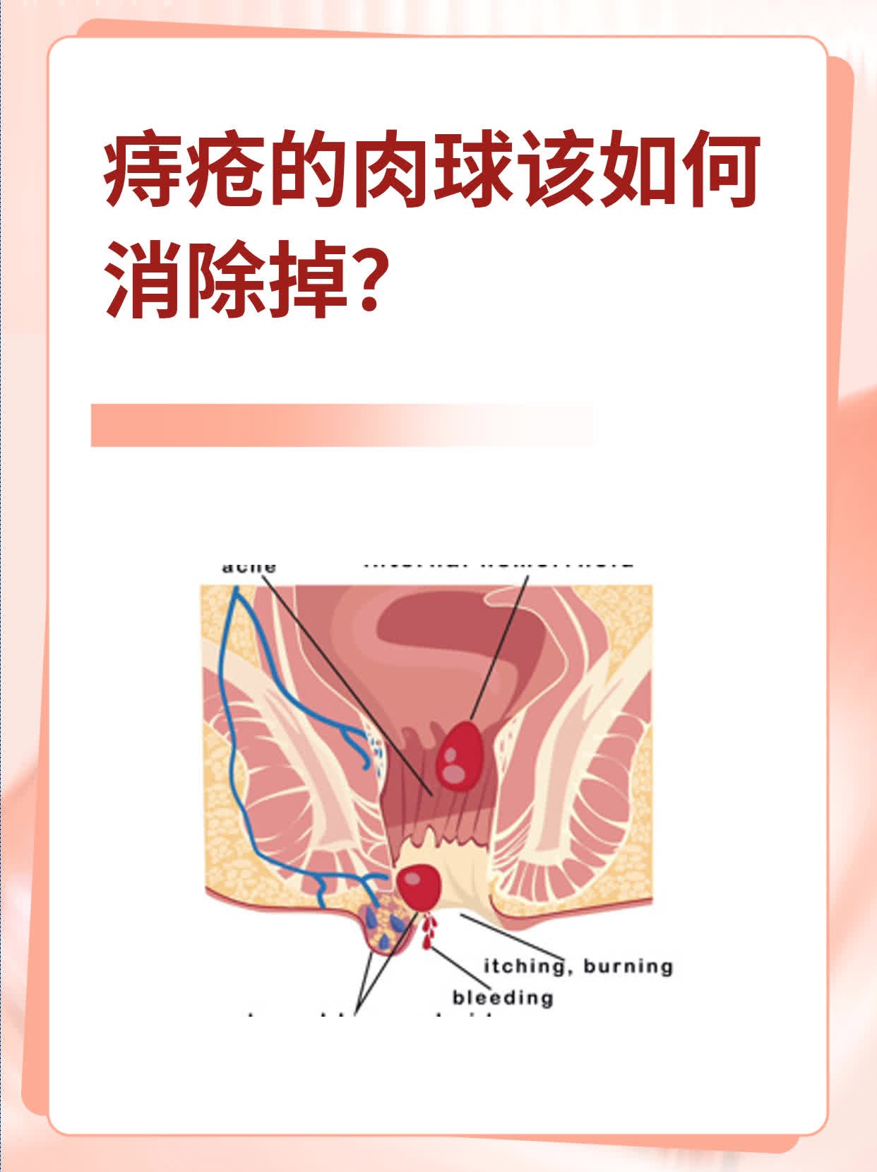 怎么消除痔疮小肉球图片