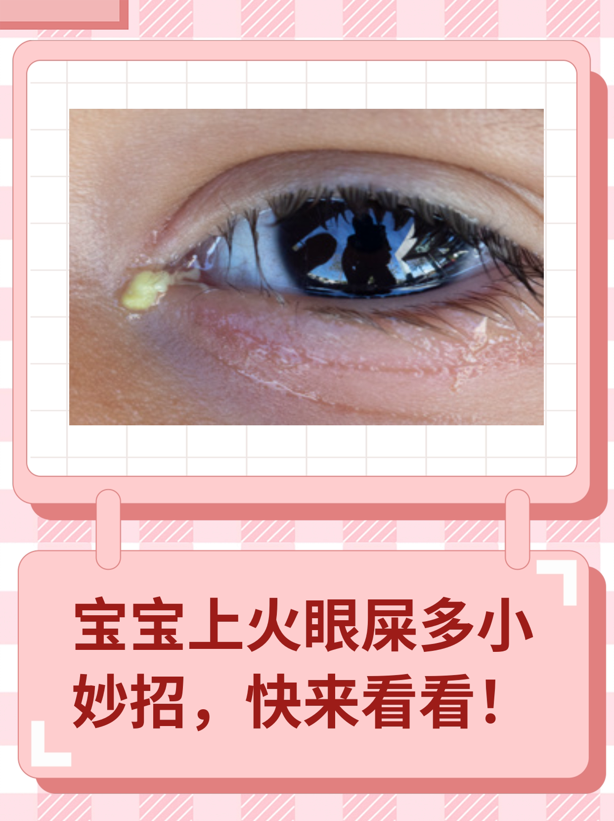 宝宝上火眼屎多小妙招,快来看看吧