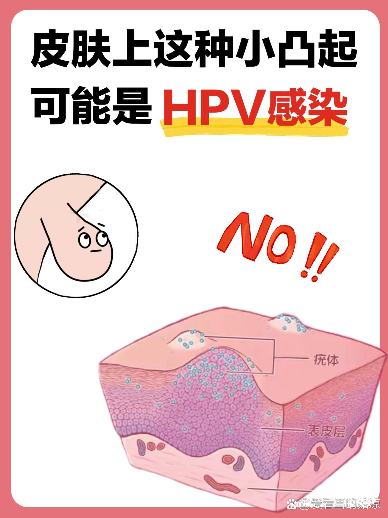 p>身上的小肉揪,竟然是hpv感染6315 br>大家都知道,hpv分为高危