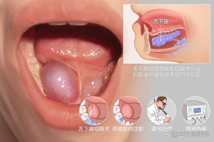 04什么是舌下腺囊肿71