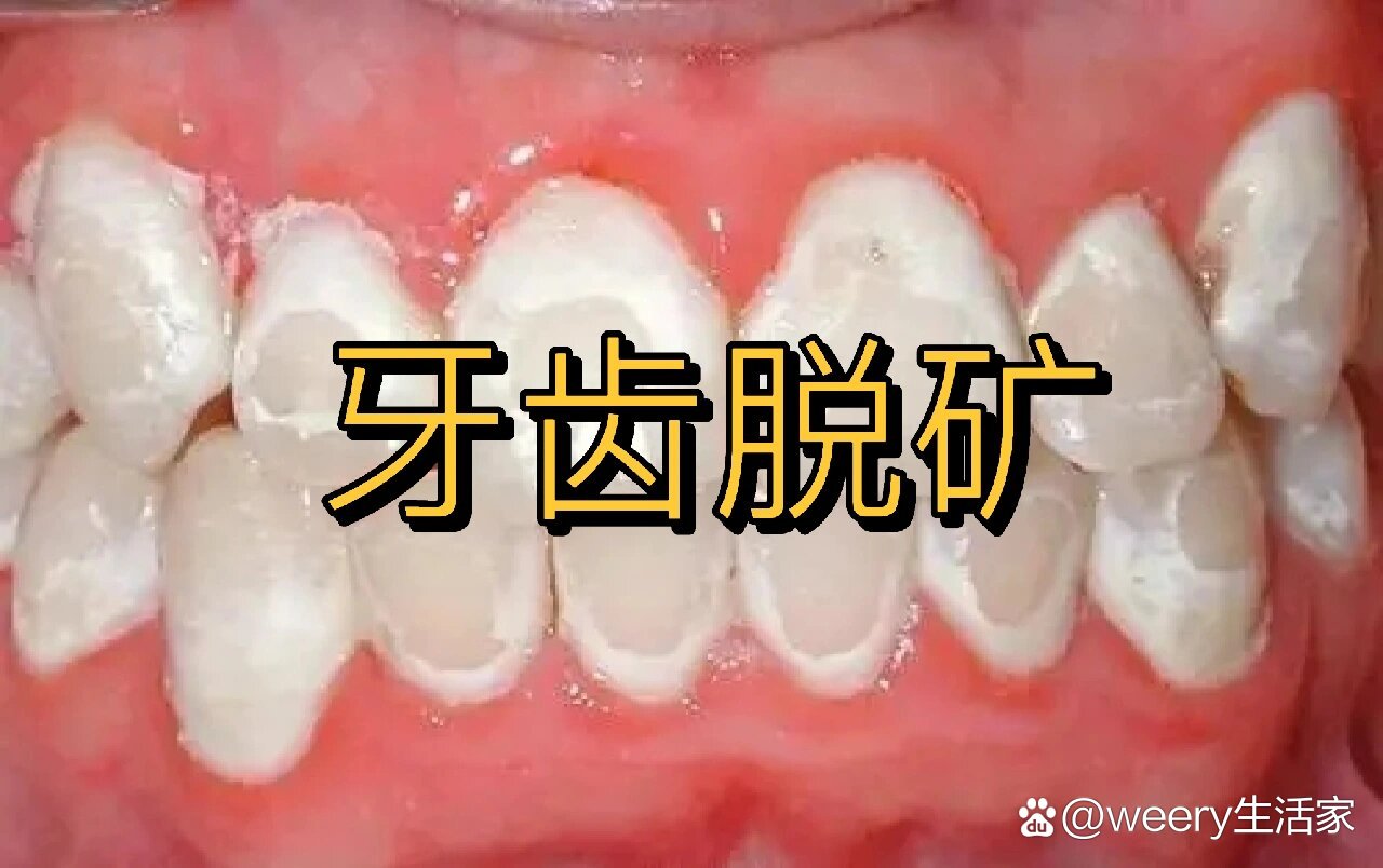 门牙上有白斑图片图片