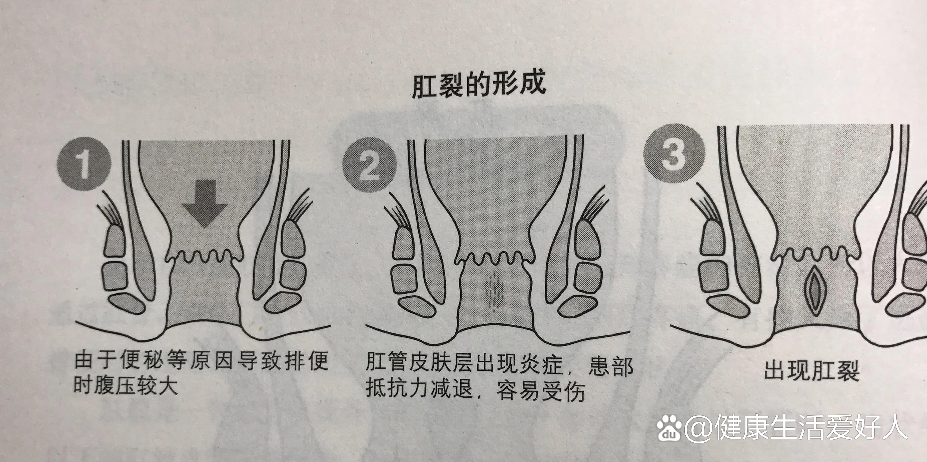 肛门口褶皱皮赘图片图片