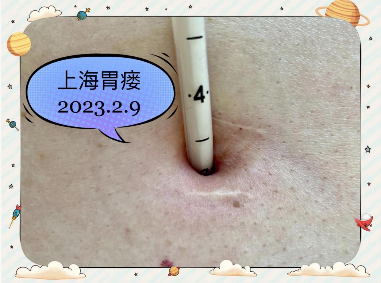🏠居家换管后，如何验证胃造瘘管位置？