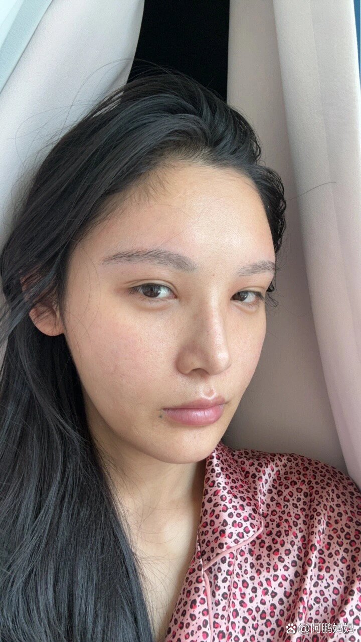 打完溶解酶肿胀