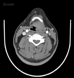 要关注自己的症状,患声门上型喉癌后接受治疗