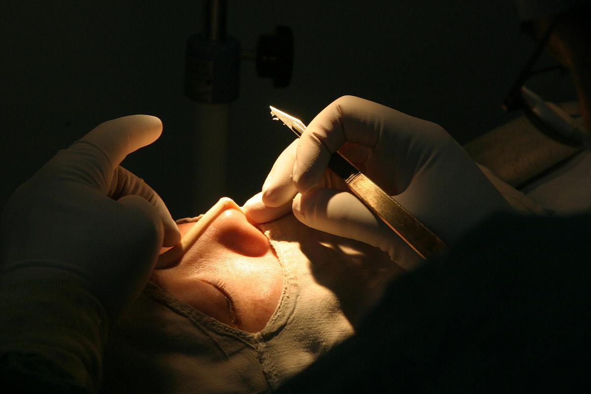 想要更美的鼻子?不妨试试医美耳软骨隆鼻,瞬间变美不是梦!