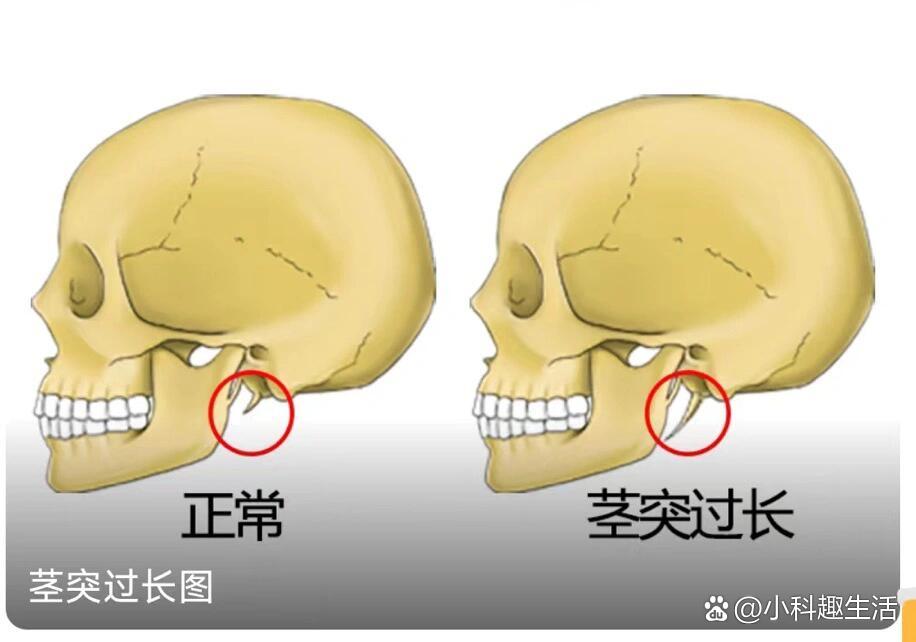 茎突长图片