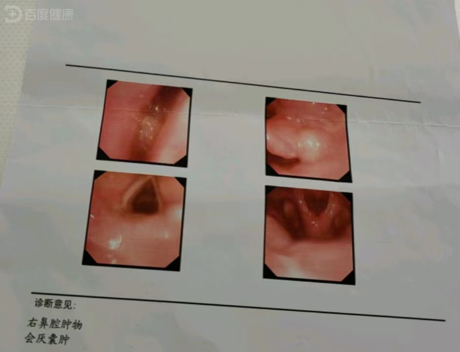 一例鼻腔鳞状细胞癌的诊治体会