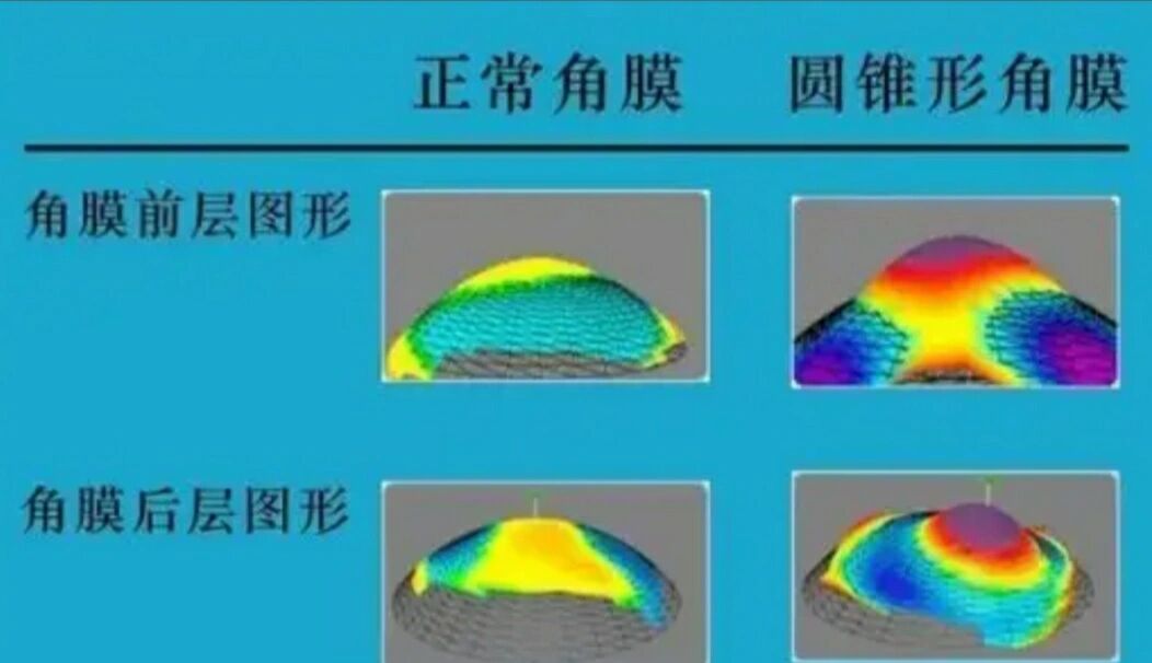 圆锥角膜图图片