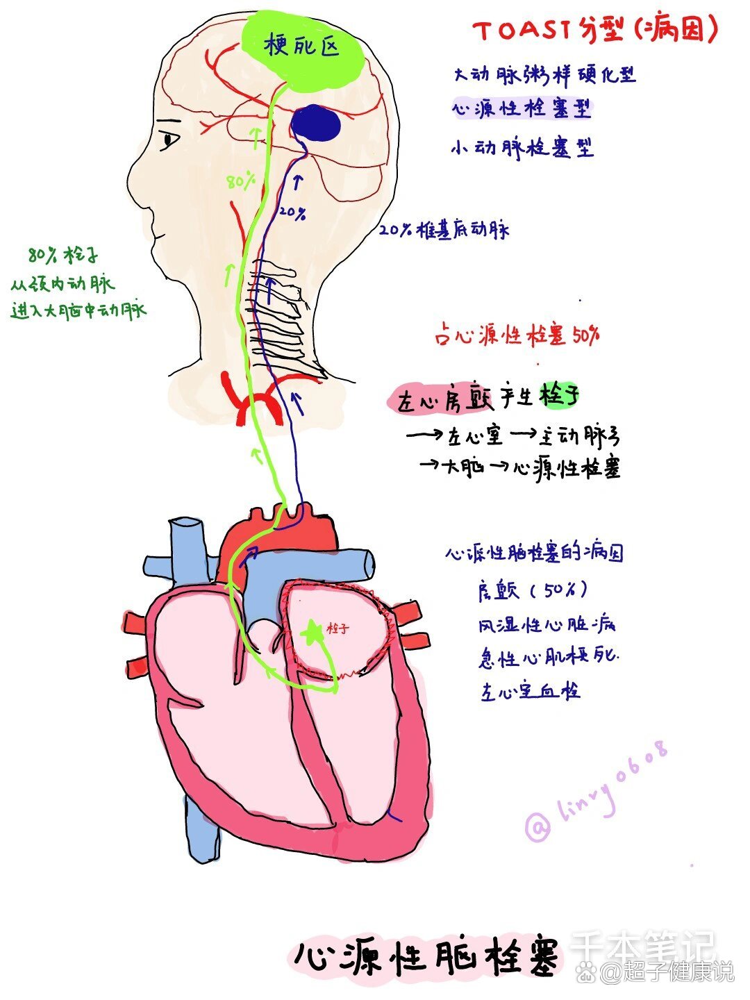  p>医学生绘本96第七弹【脑梗死】 br>图11566是心源性脑栓塞