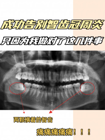 成功告别智齿冠周炎，只因为我做对了这几件事