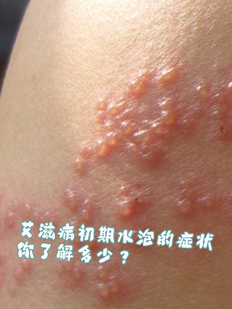 艾滋病初期水泡的症状,你了解多少?