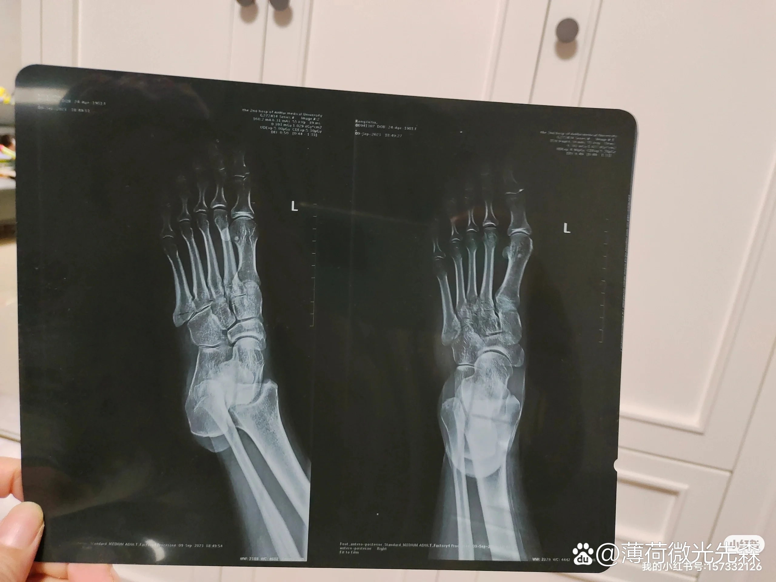 今天真是我的幸运日啊,第五跖骨骨折第32天去复查,在路上就祈求老天爷