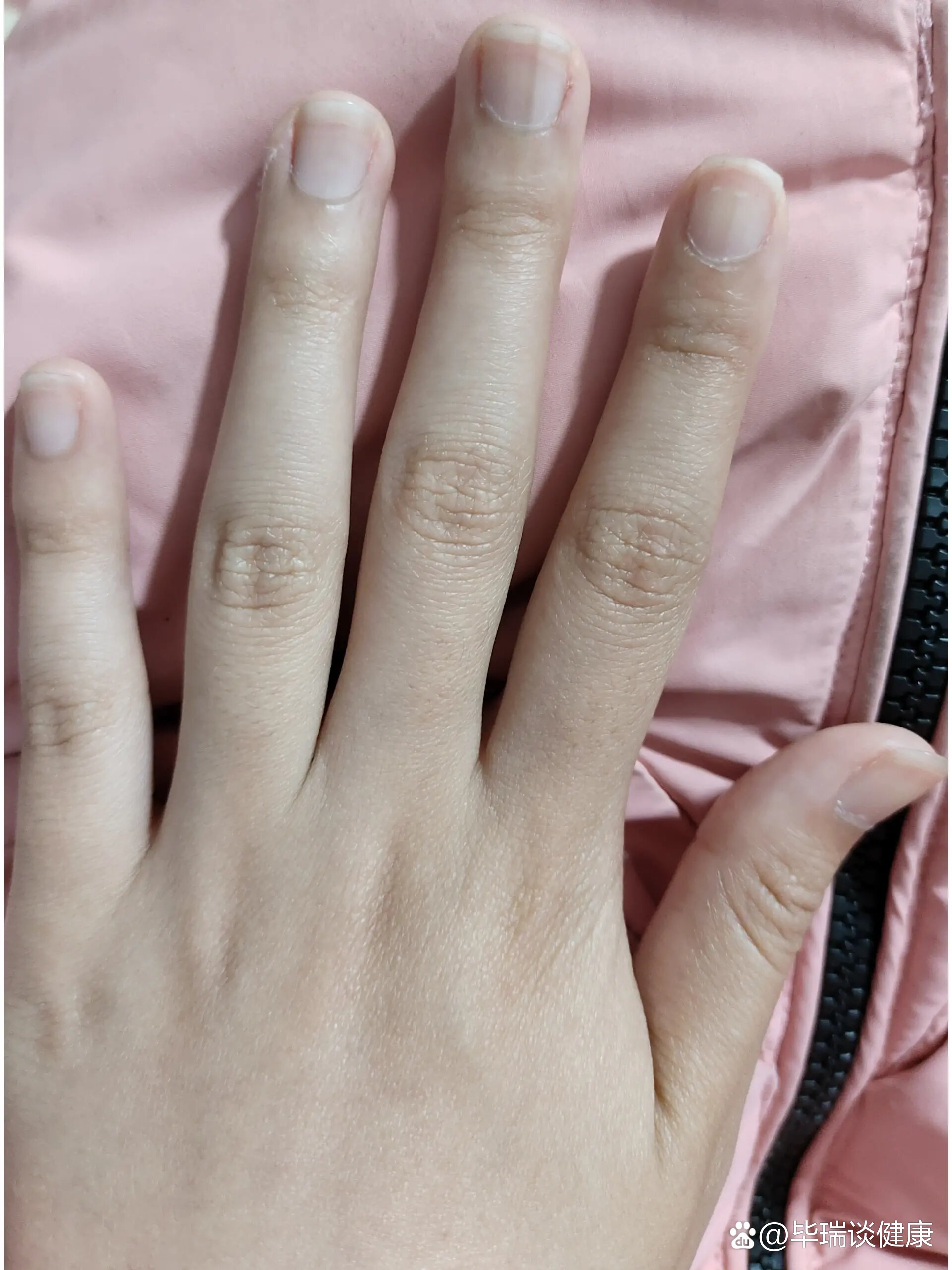 手上长了一条黑线