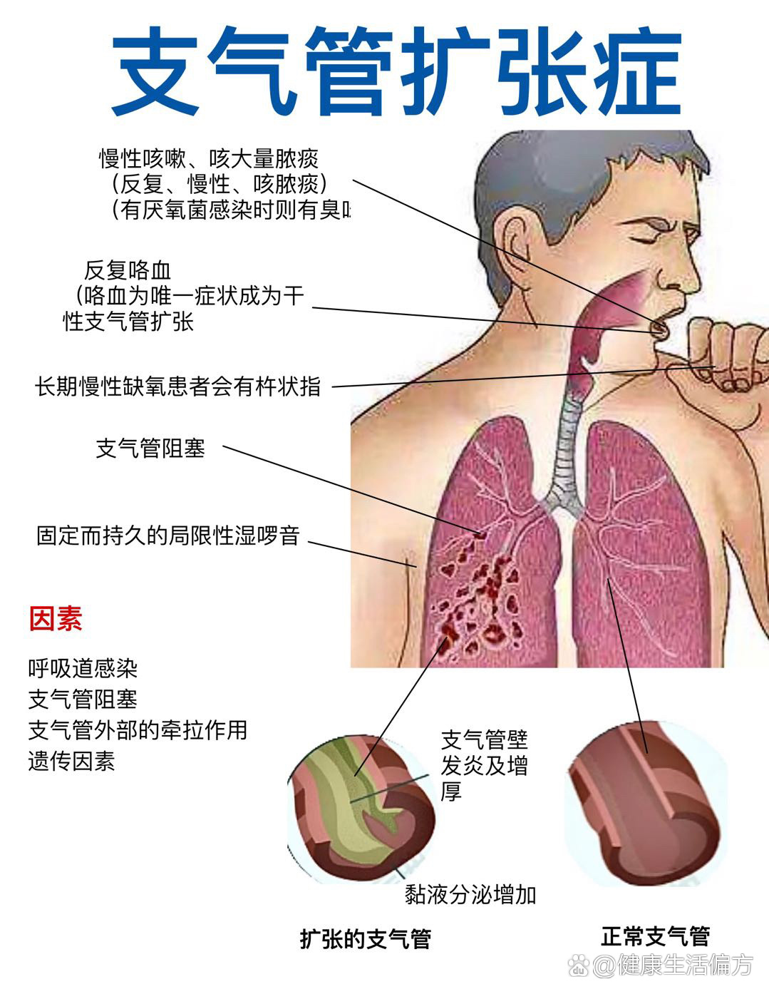 �医学笔记(病理篇)支气管扩张