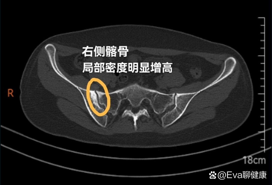 骶髂关节x片图片