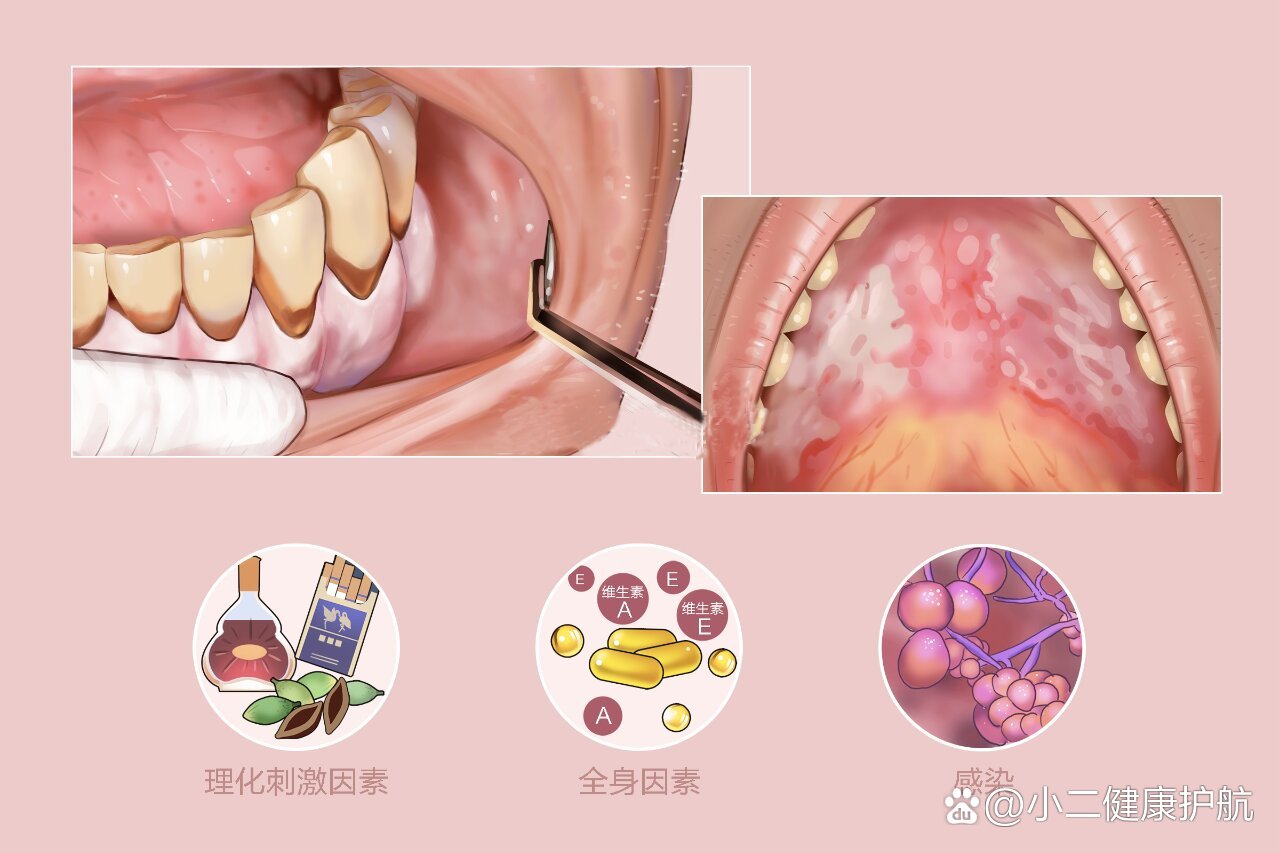 口腔粘膜白斑 全网资源