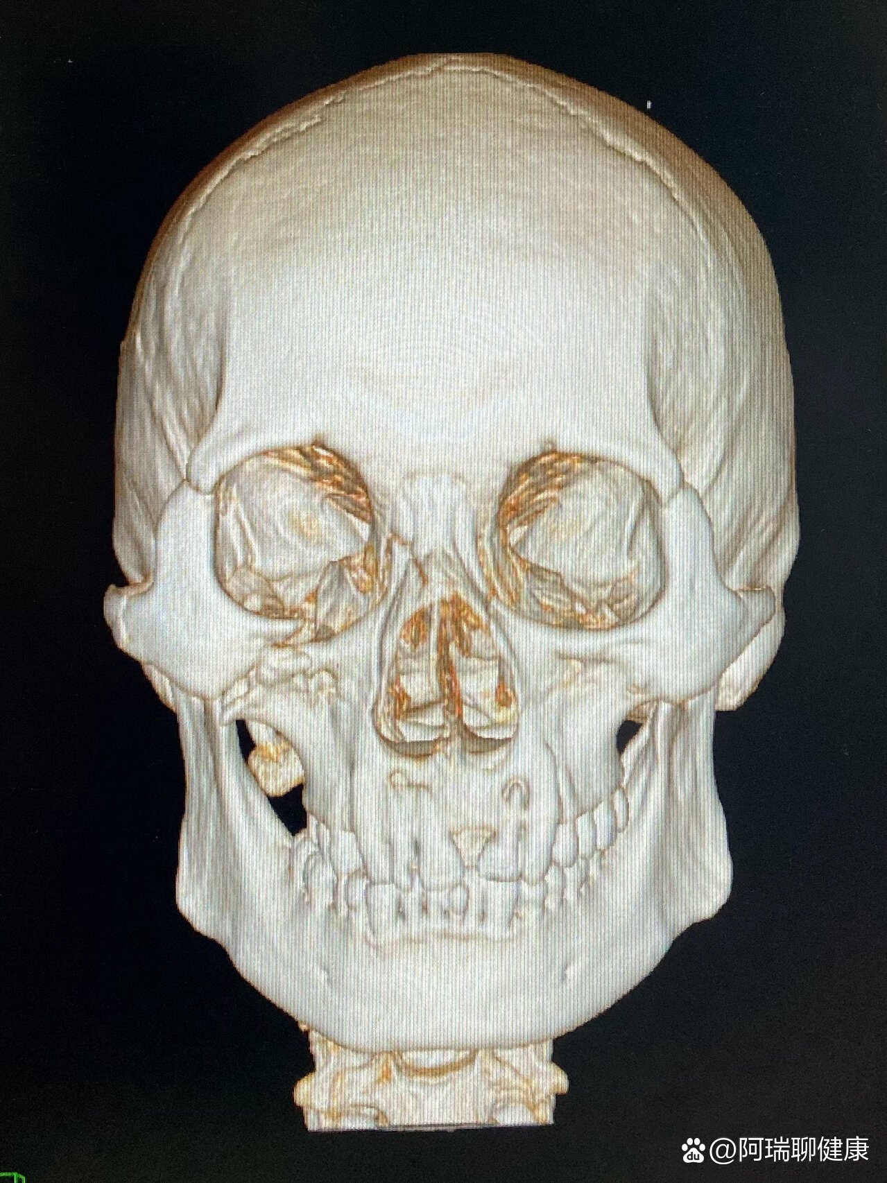 颧骨ct图片图片