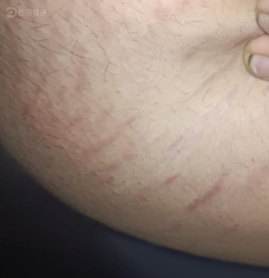 20岁年轻男子出现萎缩纹,采用维a酸乳膏涂抹渐改善