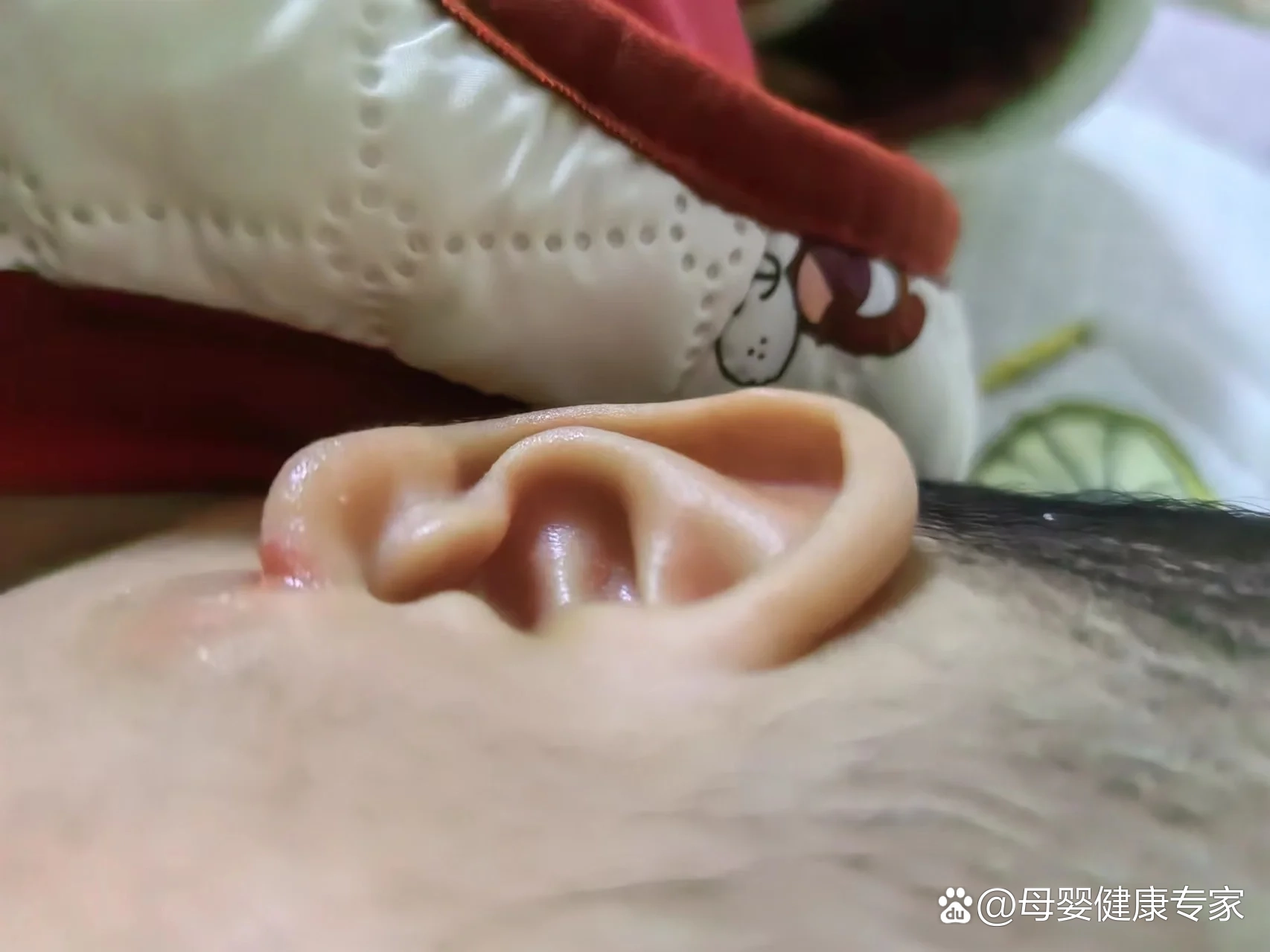 宝宝耳跟开裂怎么办呀?