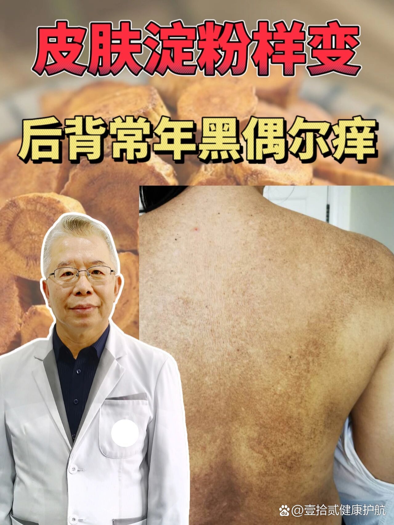后背常年黑,自觉痒感,可能是皮肤淀粉样变