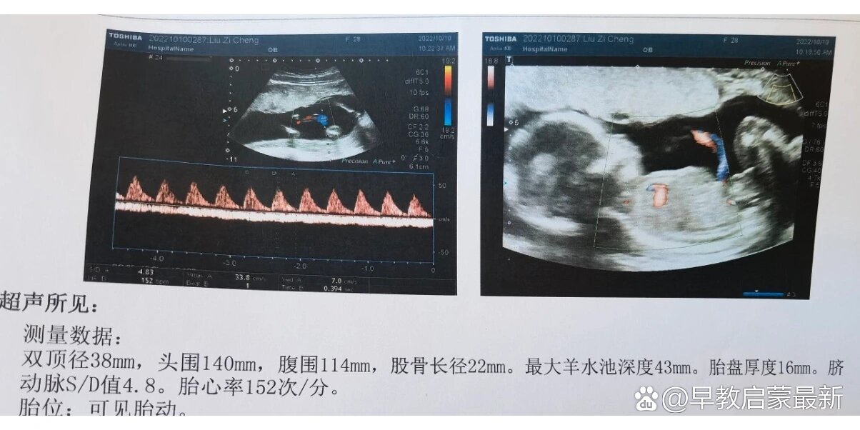 怀孕17周b超结果