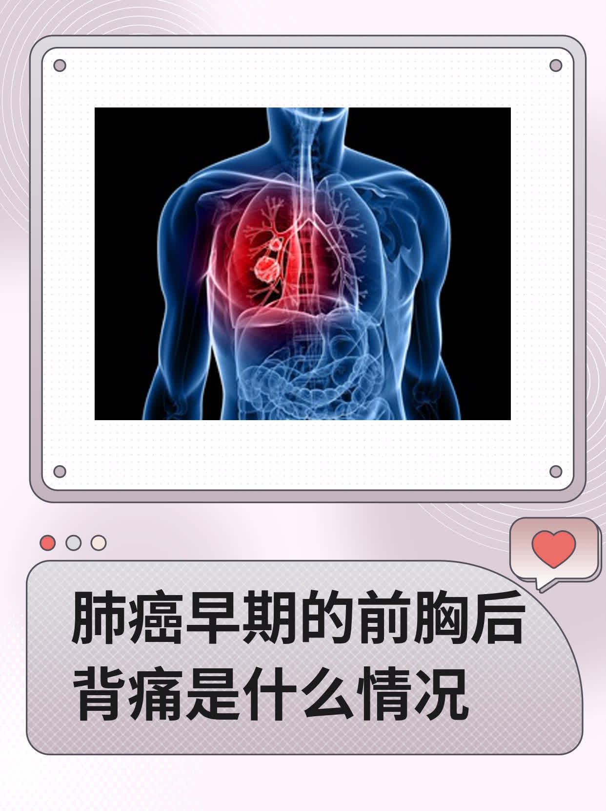 最近大家都在谈论肺癌早期症状,这不我的朋友小胡也因为这个话题跟我