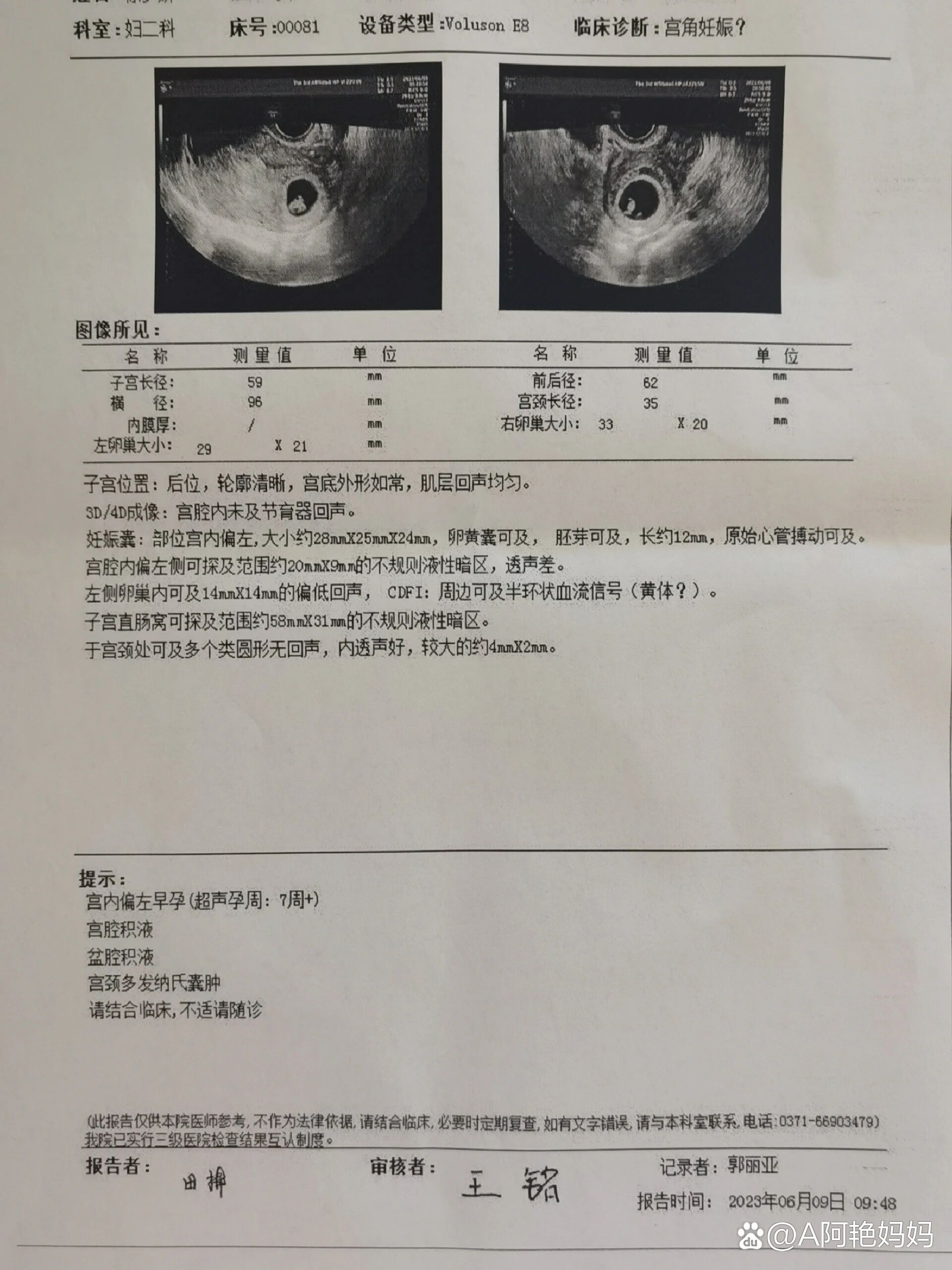 不全纵隔子宫y型图片