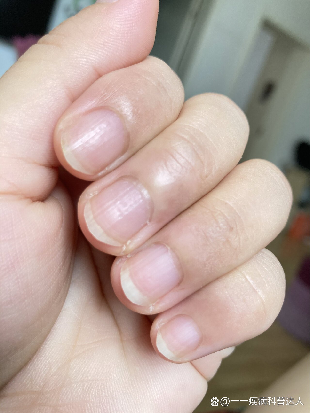 每个手指甲都长了竖纹,这个代表了什么?