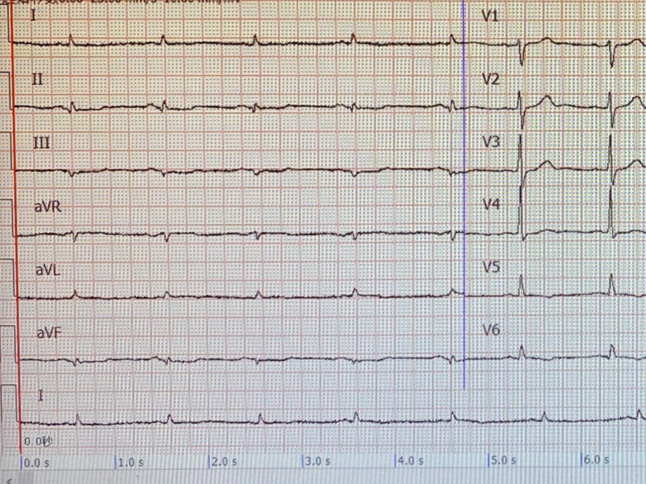 心电图电压图片