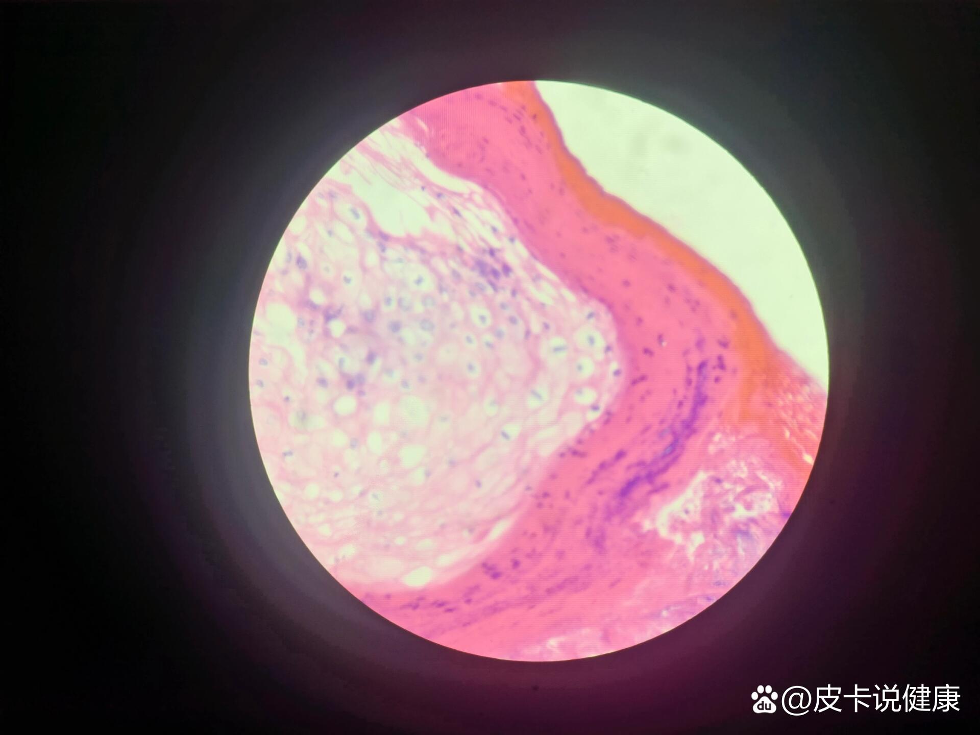 皮肤乳头状瘤