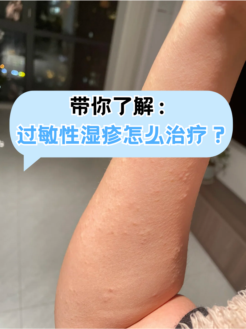 带你了解:过敏性湿疹怎么治疗?