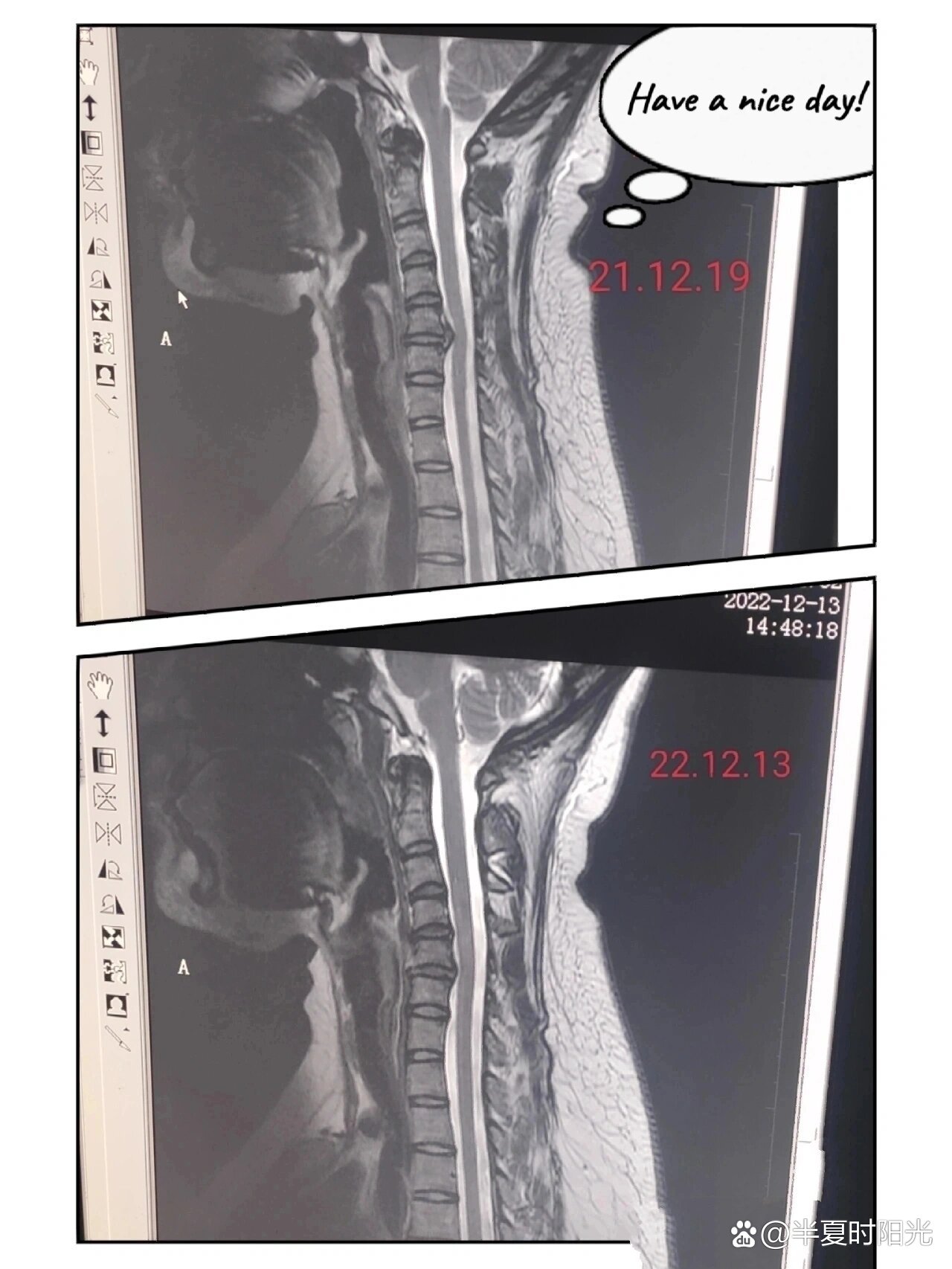 脊髓型颈椎病保守治疗成功!