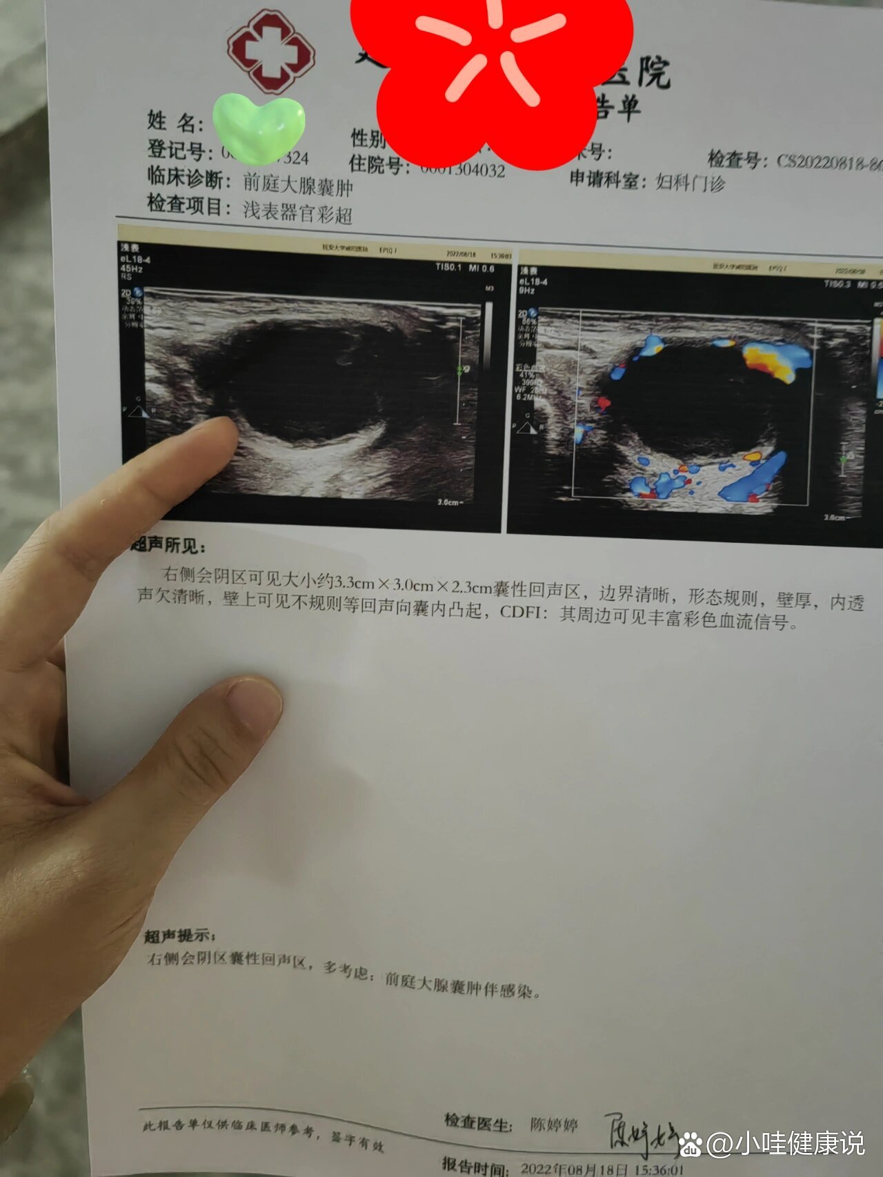 前庭大腺囊肿