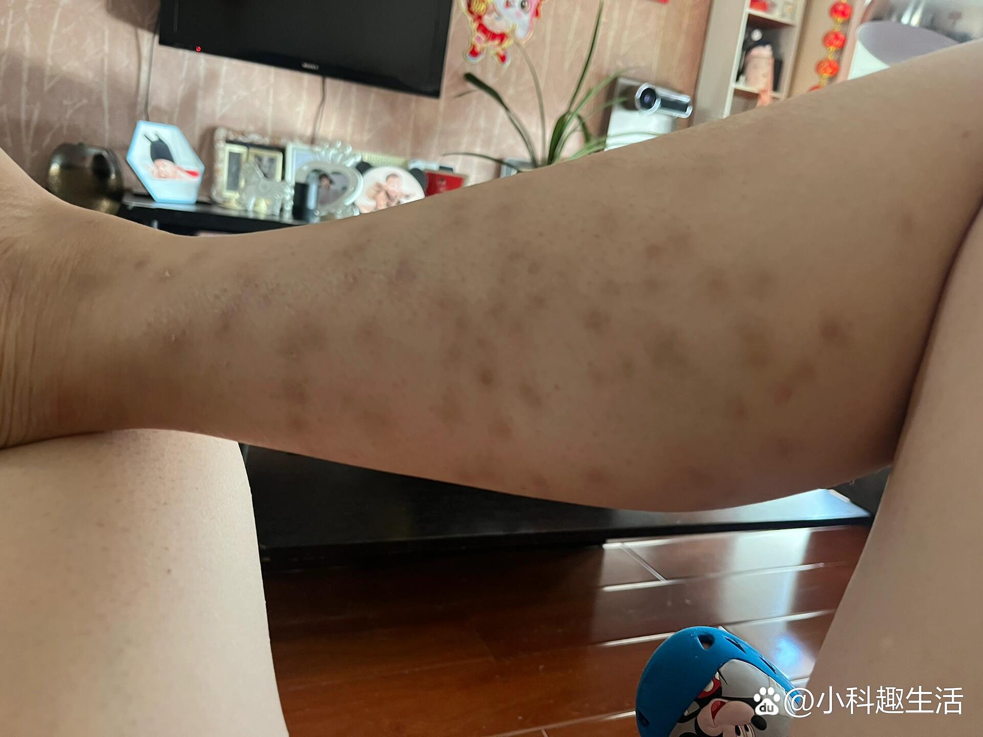 夏季蠓虫叮咬留疤后怎么恢复
