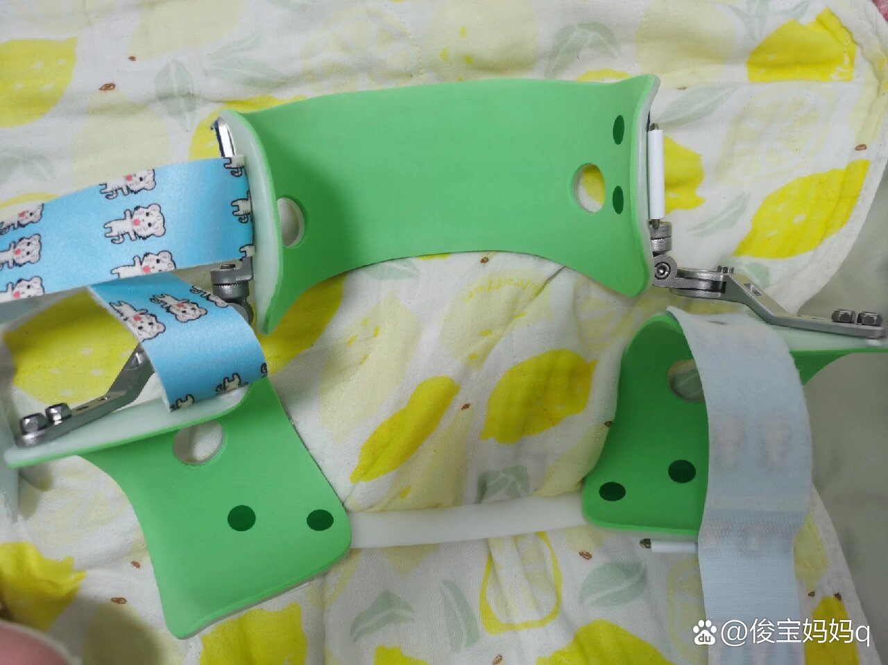 13个月宝宝戴上蛙式支具了,髋关节发育不良