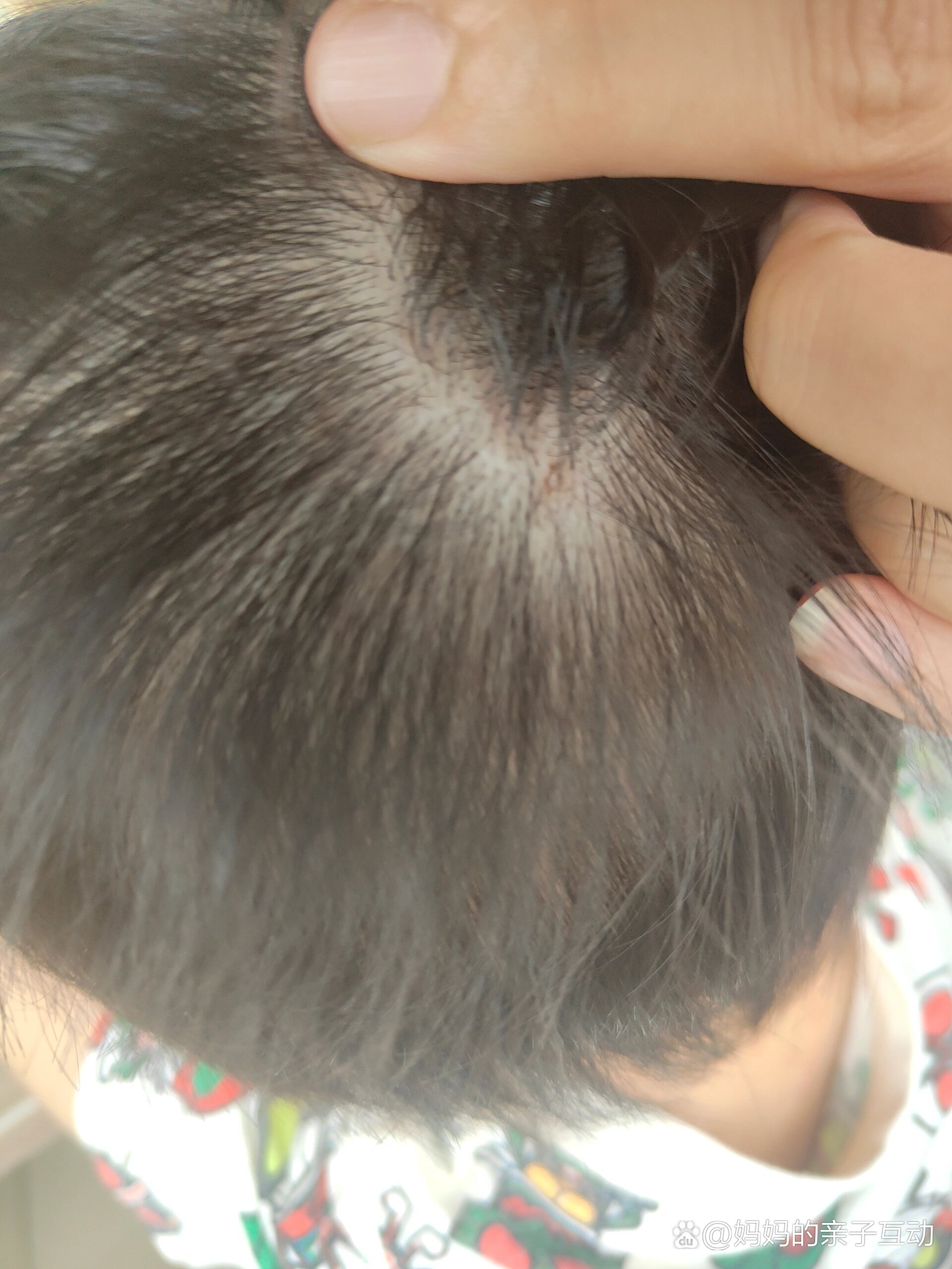 宝宝头皮溢脂性皮炎?