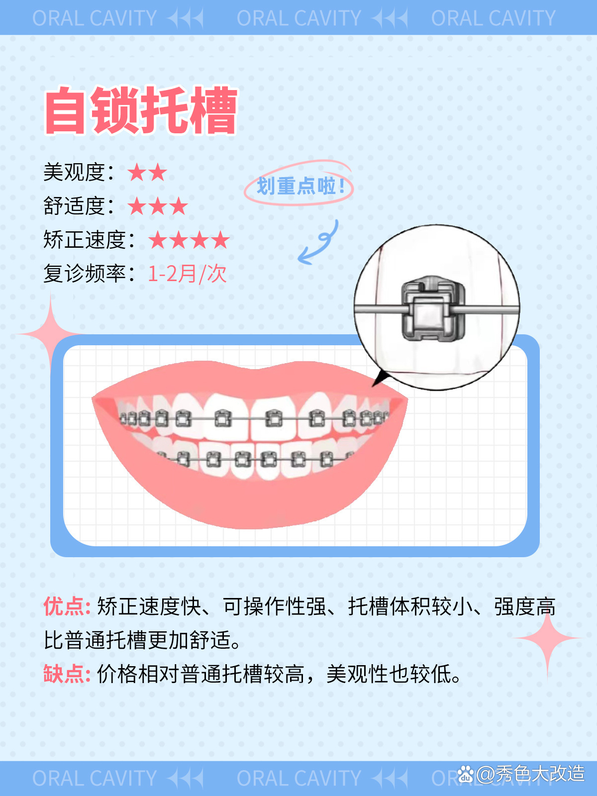 矫正牙齿选择多04正畸牙套功课之自锁托槽