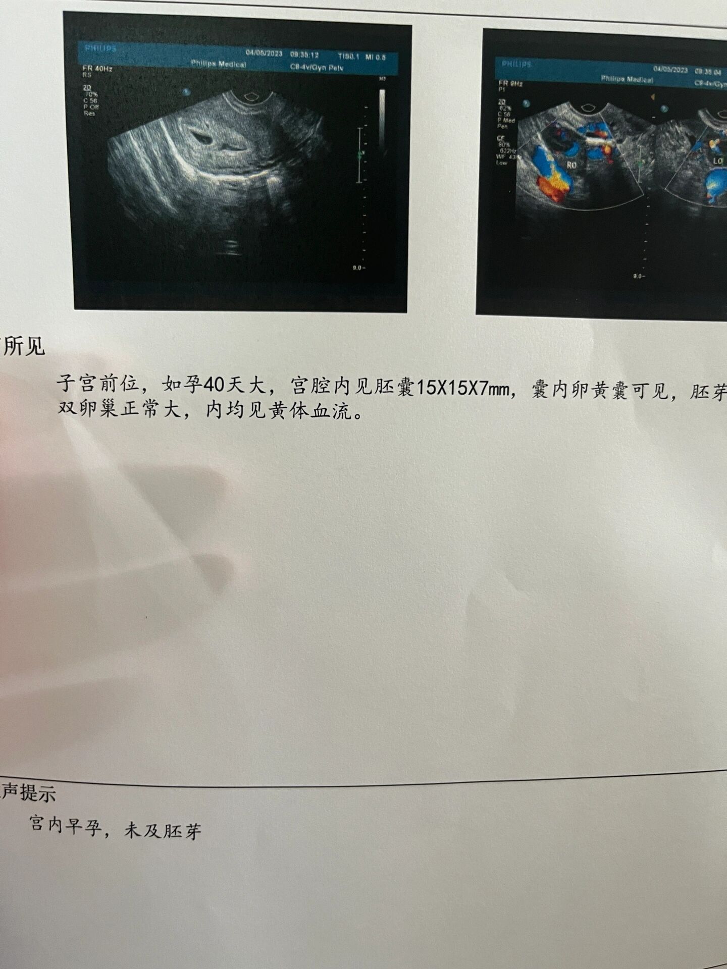最新消息药药流需要多少钱分享(你知道药流大概多少钱吗?) 最新消息药药流需要多少钱分享(你知道药流大概多少钱吗?)