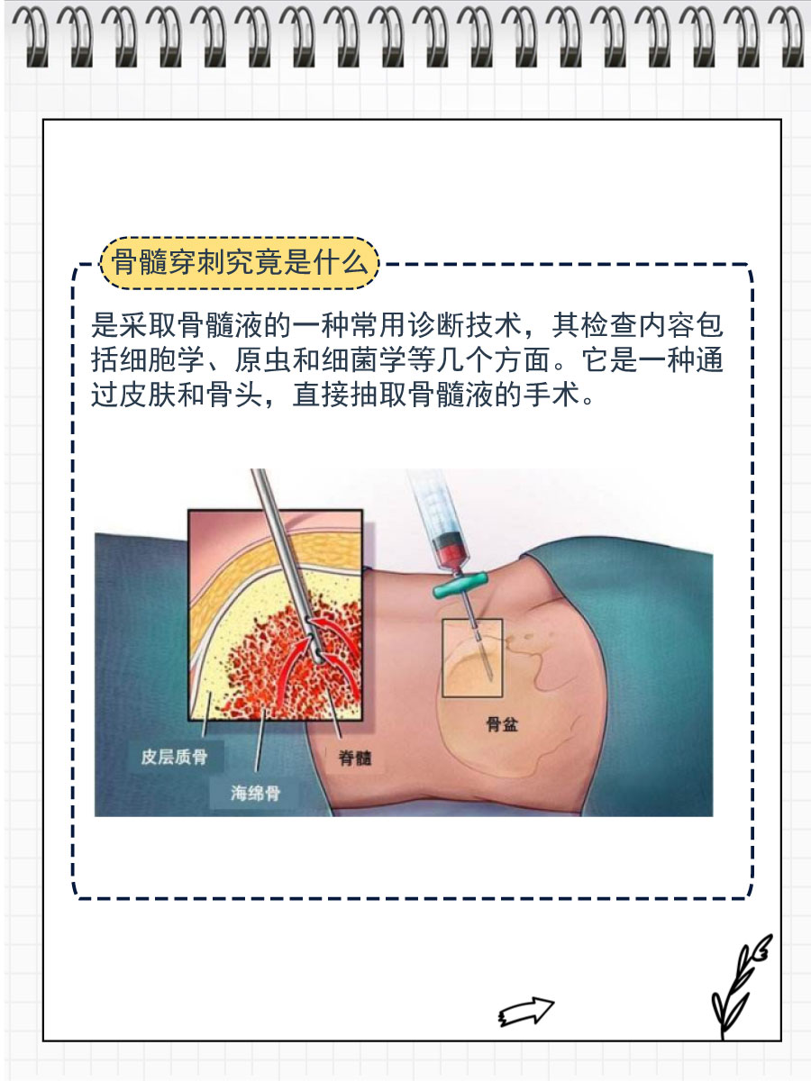 骨穿刺怎么做过程图片图片