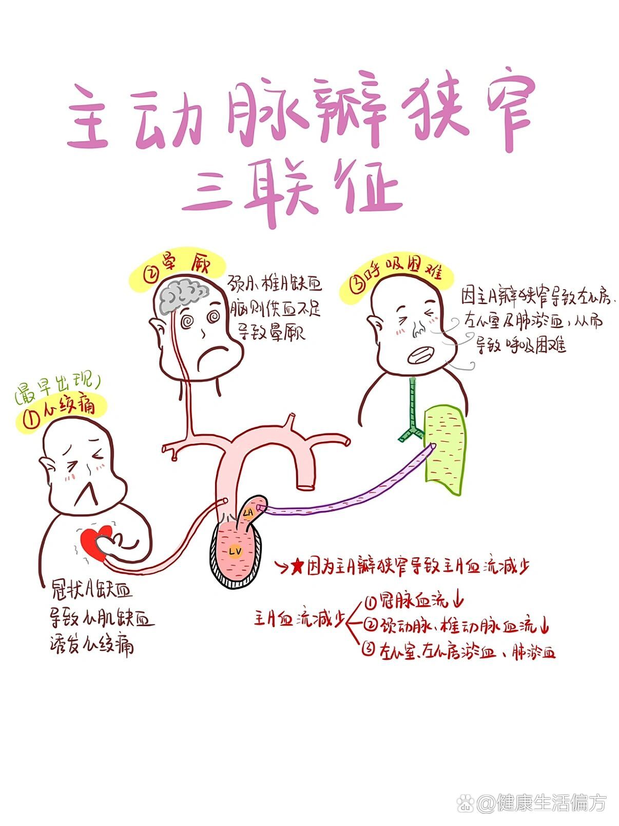 主动脉瓣上缩窄图片