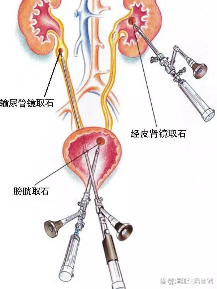 肾结石排出过程图图片