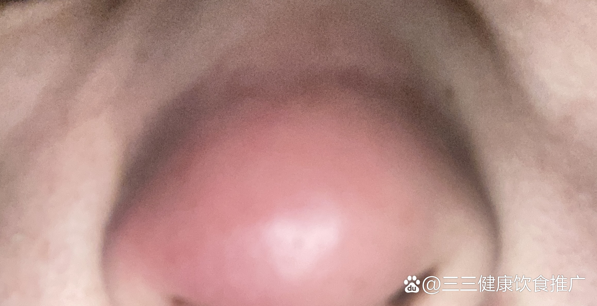 我自己乱摸乱挤,半张脸都肿了,呼吸都在痛输了三天液,还没消炎 /p>