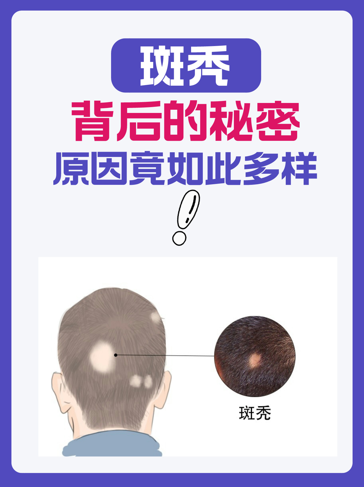 斑秃背后的秘密:原因竟如此多样!