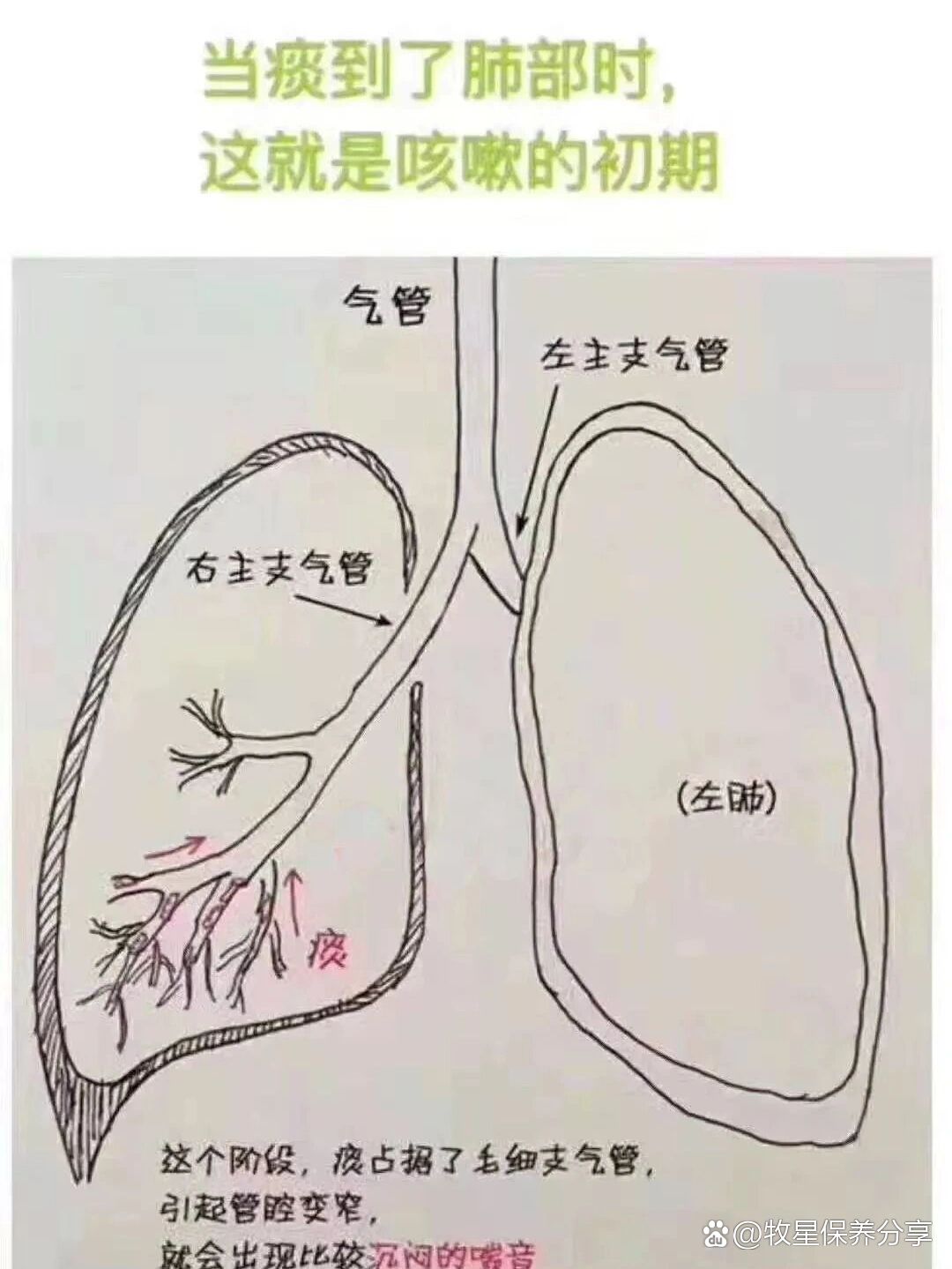 咳嗽4个阶段:干咳无痰➡动痰➡咳喘➡排痰