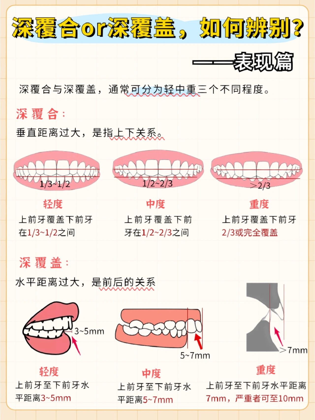 深覆合与深覆盖如何区分?