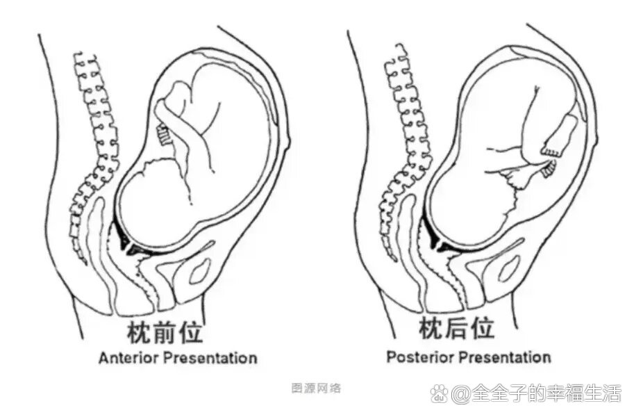 产后科普了一下"枕后位",不禁后怕