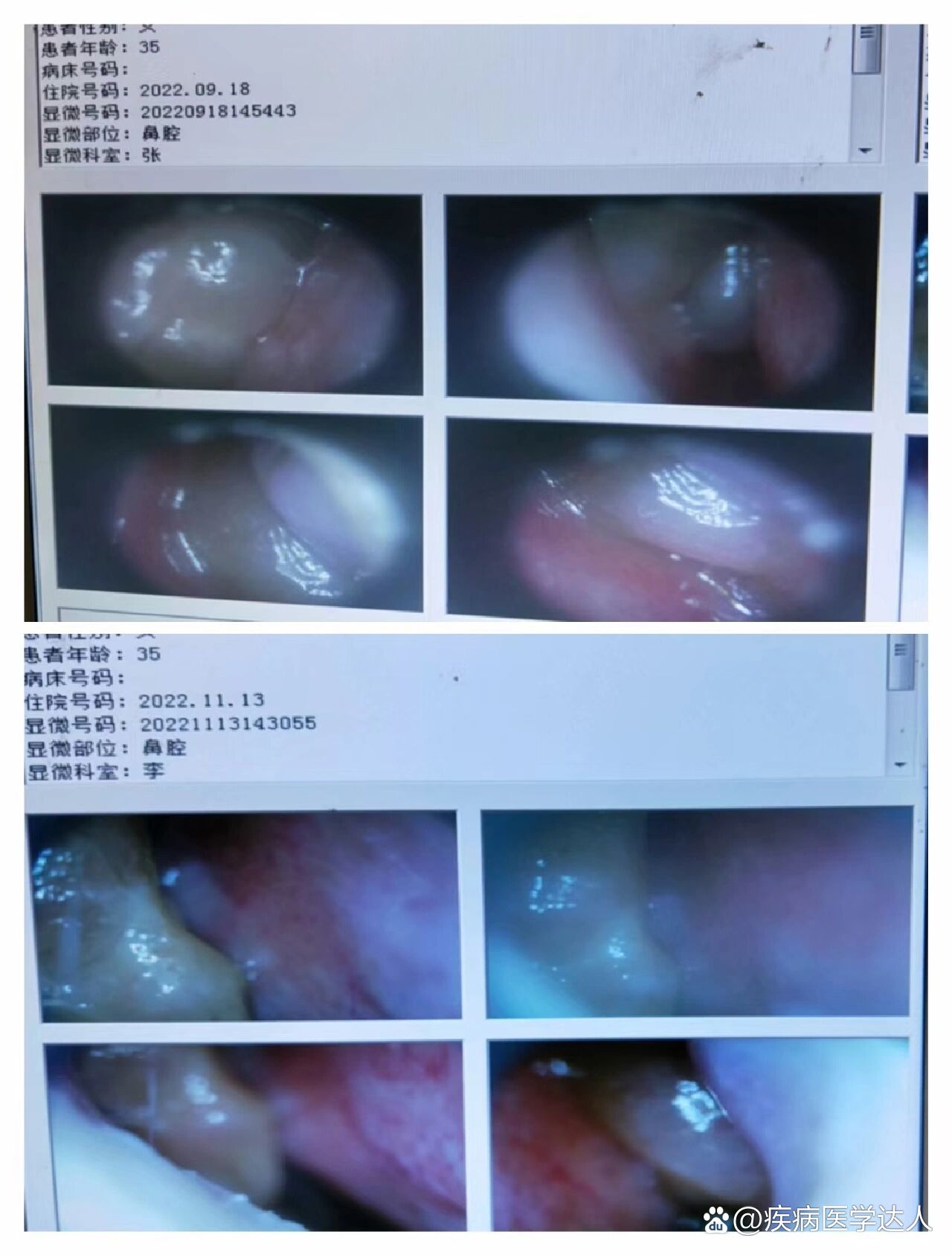 鼻息肉不需要手术也可以