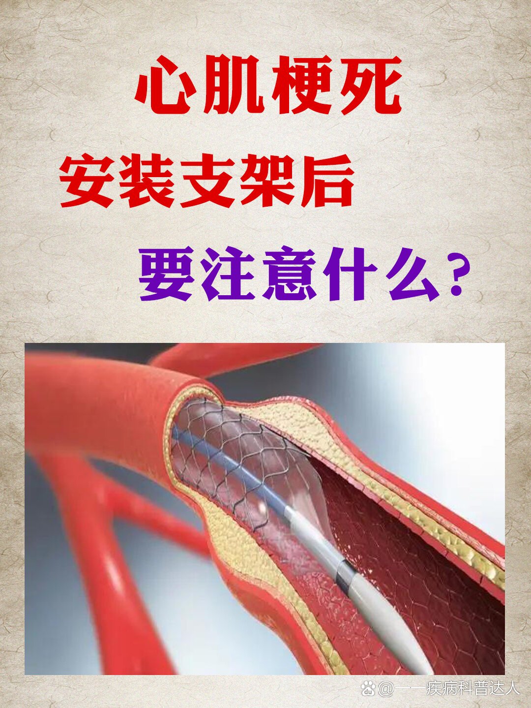 心肌梗死安装支架后要注意什么?